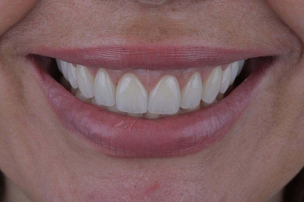 Después — diseño de sonrisa carillas