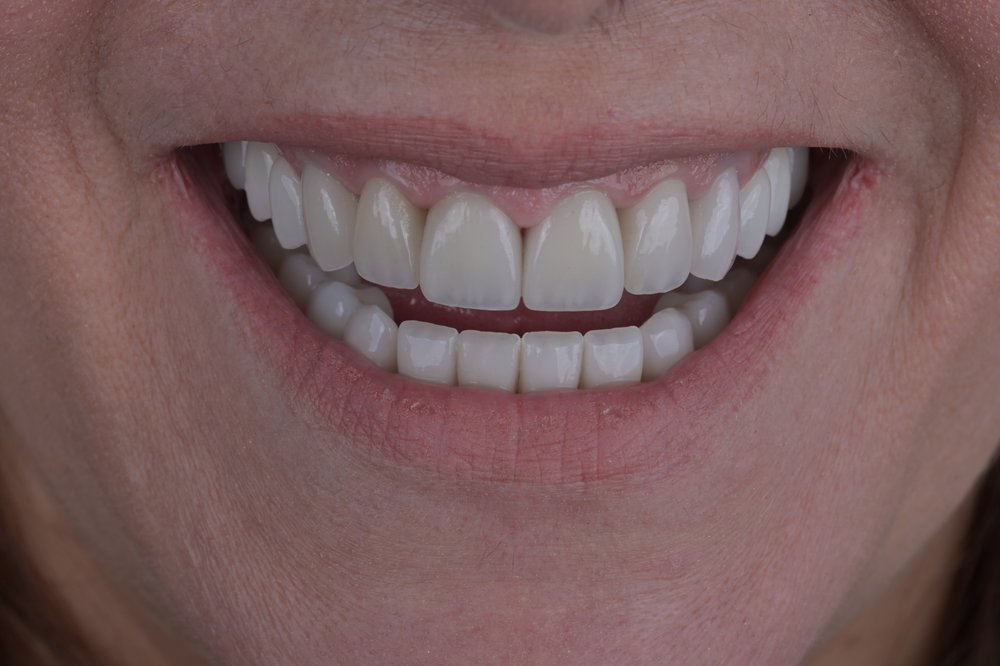 Después — diseño de sonrisa carillas