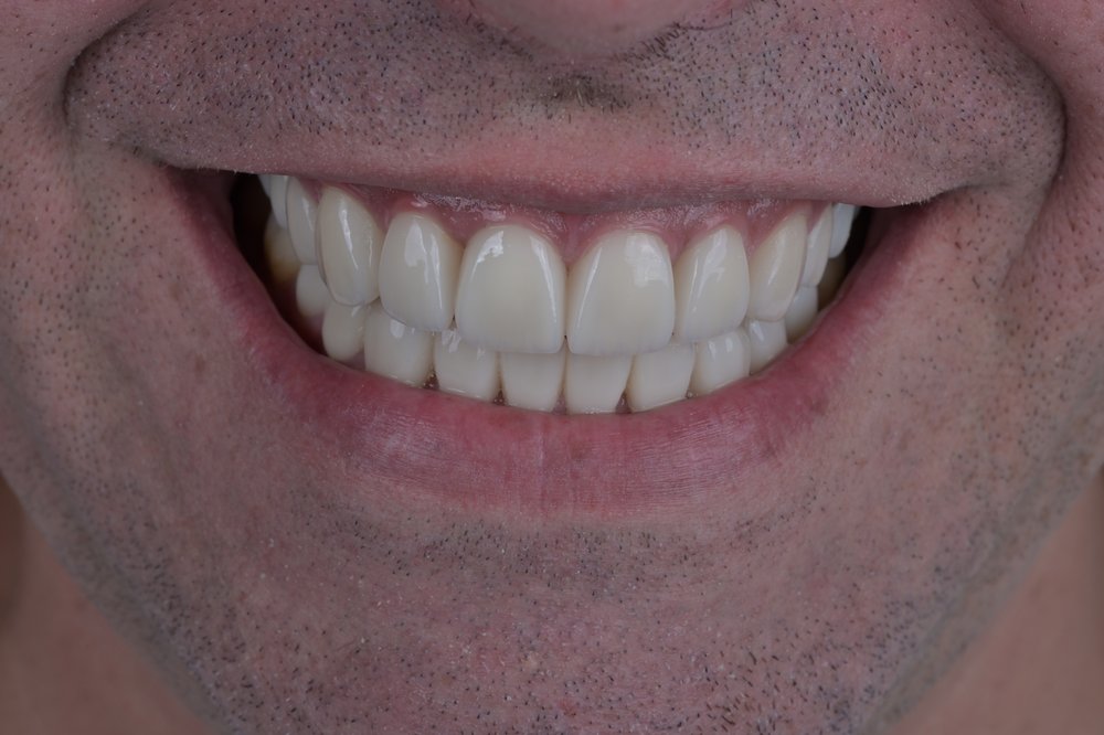 Después — diseño de sonrisa carillas