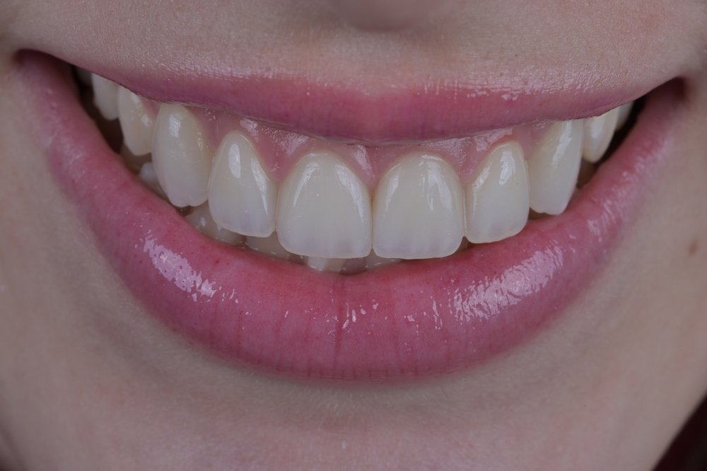 Después — diseño de sonrisa