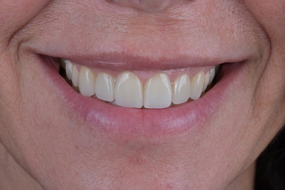 Después — diseño de sonrisa carillas