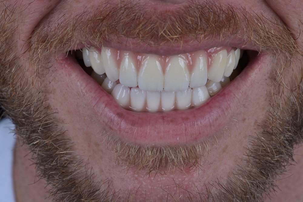 Después — alineadores invisibles