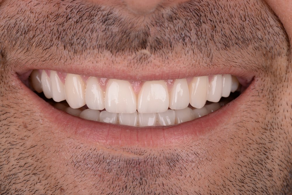 Después — diseño de sonrisa carillas