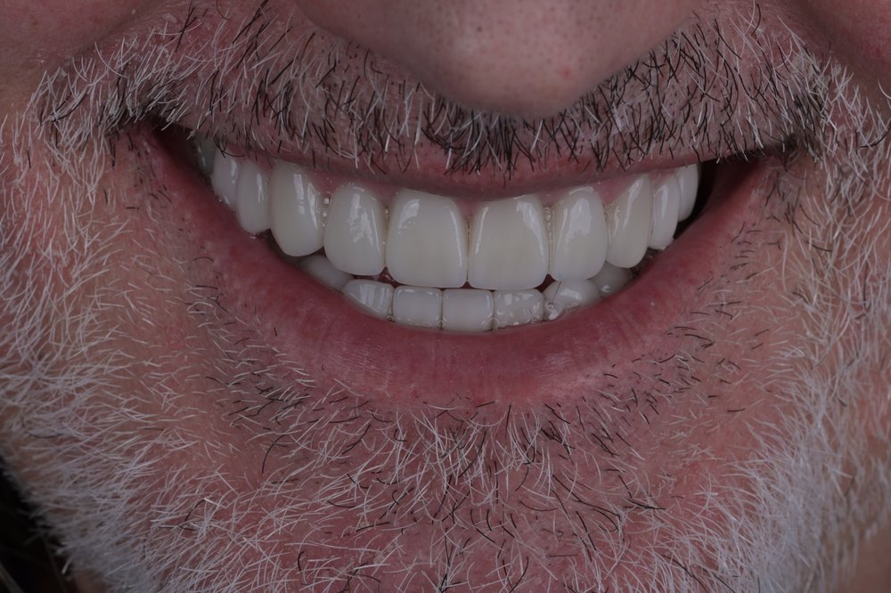 Después — carillas composite