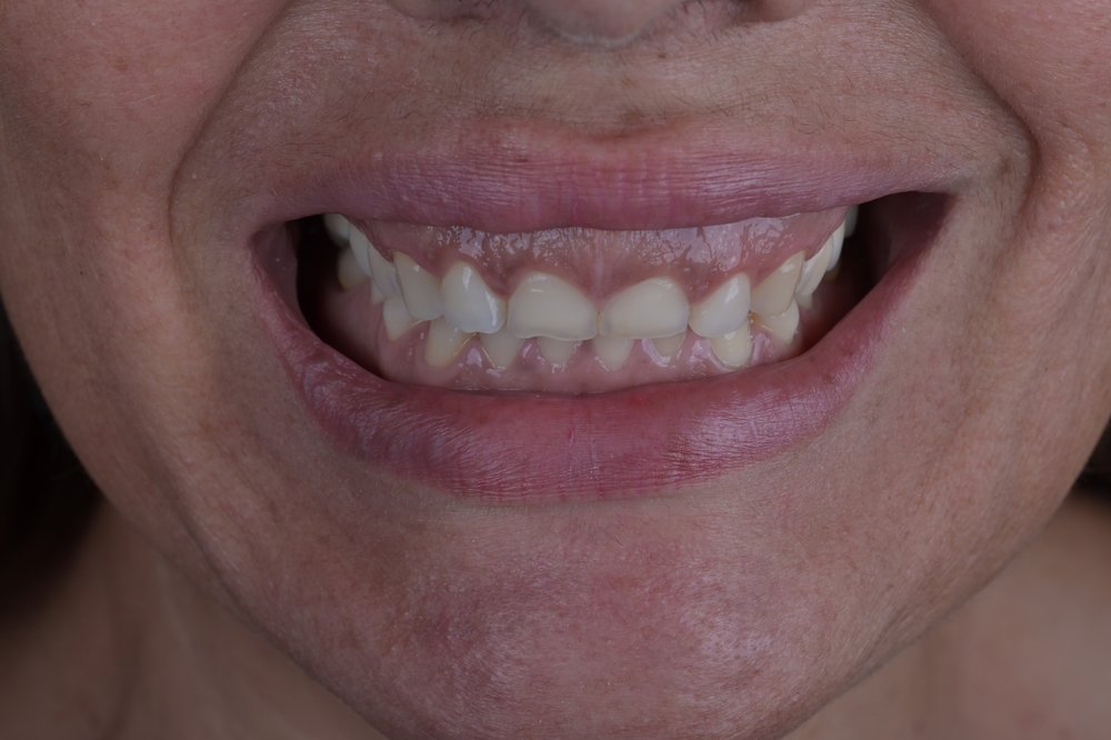 Antes — diseño de sonrisa carillas