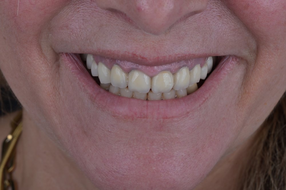 Antes — diseño de sonrisa carillas