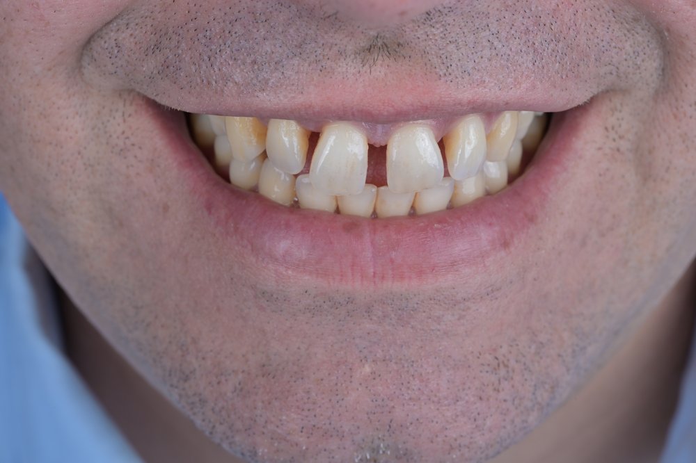 Antes — diseño de sonrisa carillas