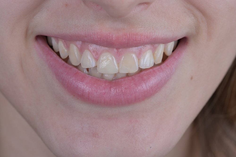 Antes — diseño de sonrisa