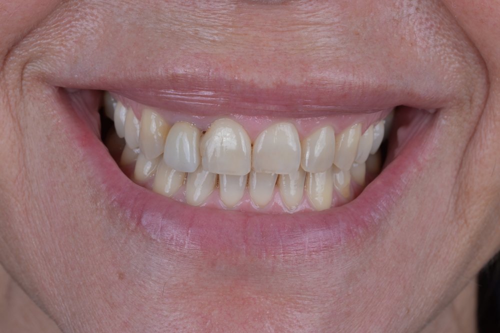 Antes — diseño de sonrisa carillas