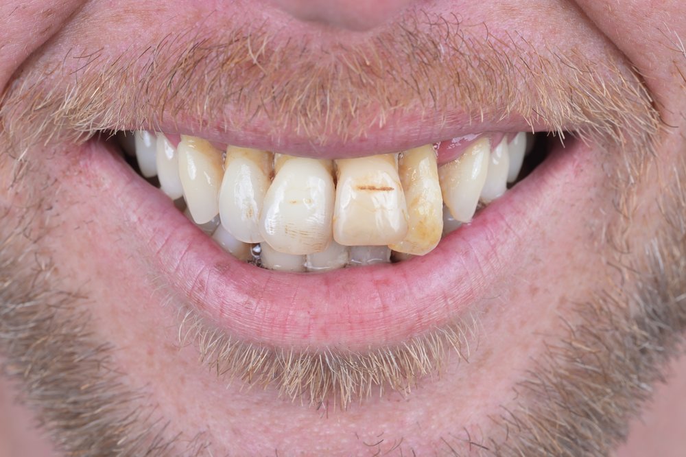 Antes — alineadores invisibles