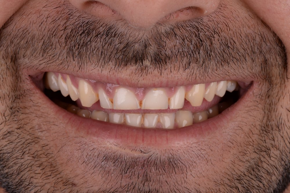 Antes — diseño de sonrisa carillas