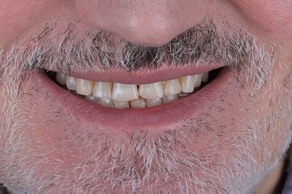 Antes — carillas composite