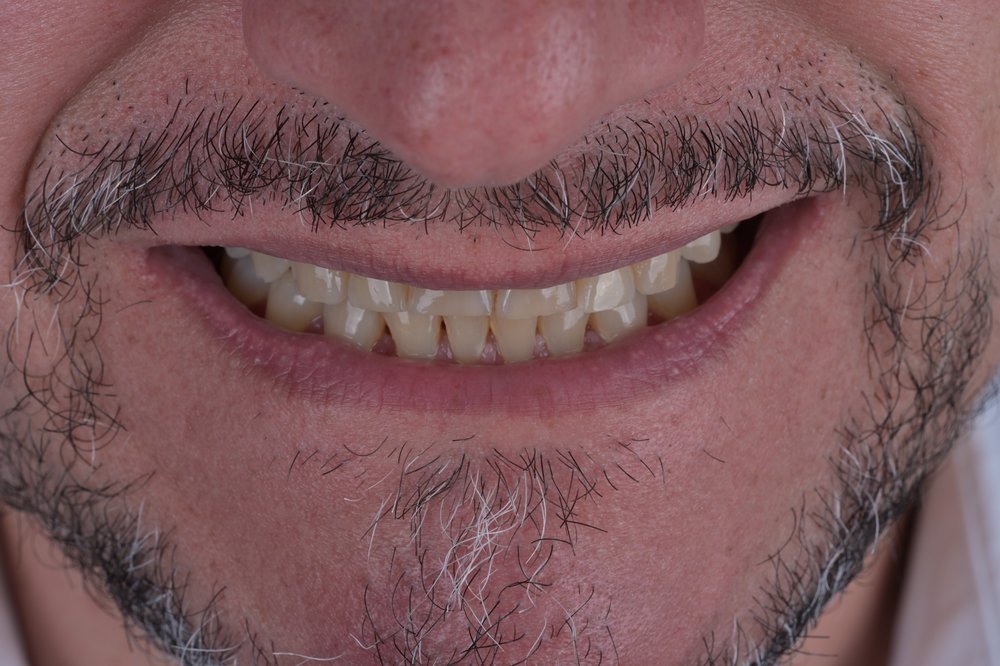 Antes — diseño de sonrisa carillas