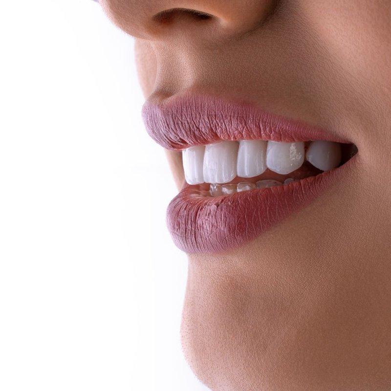 Carillas Dentales de Porcelana Barcelona — Sergi Arranz